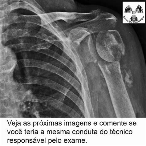 Dicas De Radiologia Tudo Sobre Radiologia Imagens Radiol Gicas Fratura De Mero