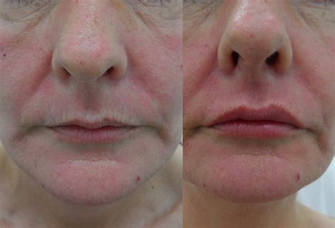 Maybe you would like to learn more about one of these? One of our beautiful clients before and after a lip ...