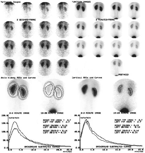 Mag3 Renogram In An Individual With Normal Kidneys As Well As Showing