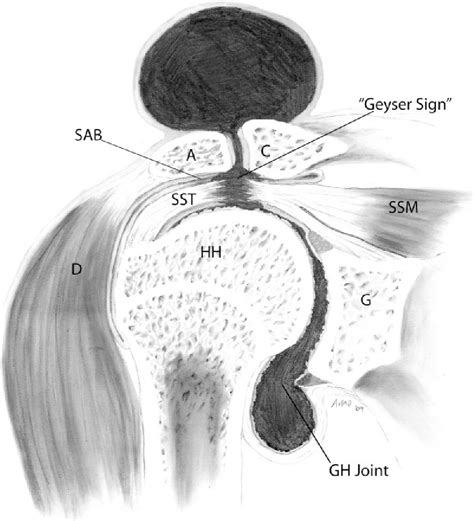 Acromioclavicular Joint Cyst Formation Semantic Scholar