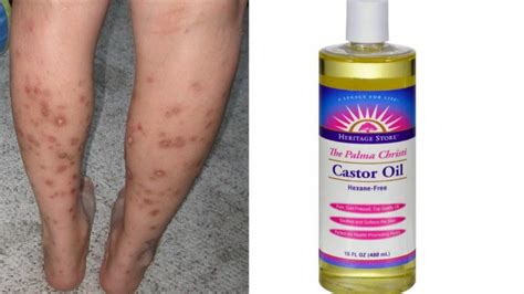 Dark Spots On Legs From Scratching Home Remedy How To Remove Dark