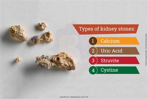 Kidney Stones Causes Symptoms And Treatment Utsav 360