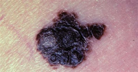 Symptoms And Pictures Of Stage Melanoma