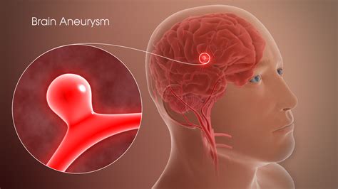 Brain Aneurysm Shown Explained Using A D Medical Animation