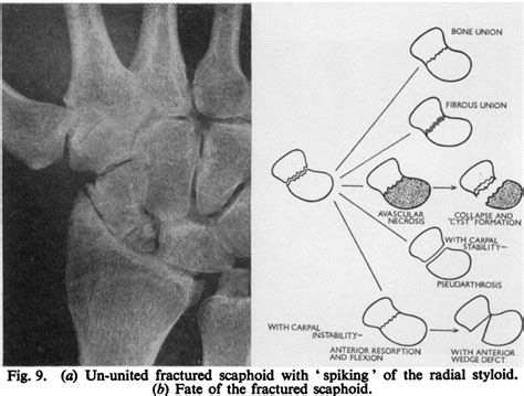 fate of the fractured scaphoid (image on right) | Work ...
