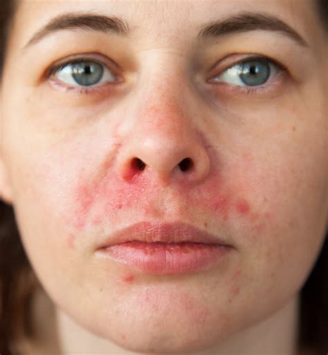 Perioral Dermatitis Top Causes And Quick Treatments