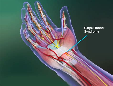Carpal Tunnel Syndrome Memphis Wrist Pain Memphis Hand Surgery Memphis