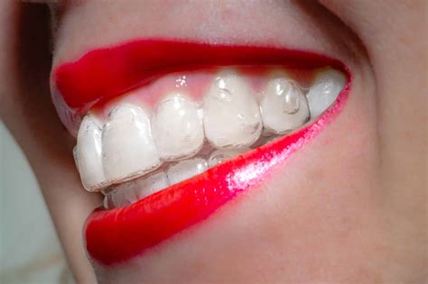Invisalign For Adults Everything You Need To Know Sing Orthodontics
