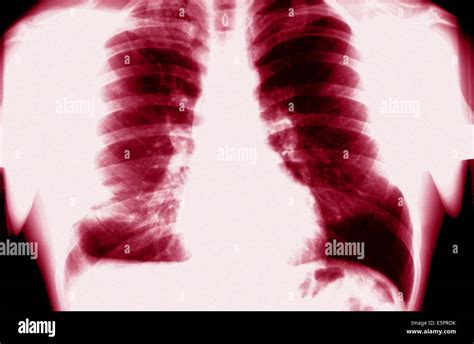 Chest X Ray Showing Tuberculosis Hi Res Stock Photography And Images