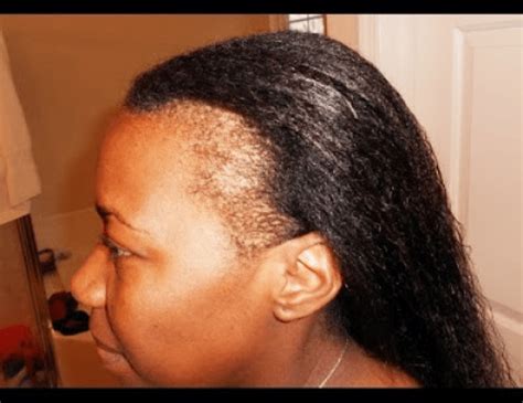 5 Natural Ways To Restore Thinning Edges