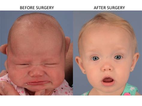 Minimally Invasive Endoscopic Sagittal Strip Craniectomy Before And