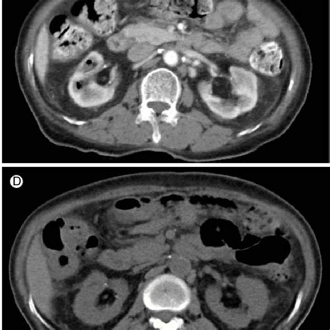 A Contrast Enhanced Abdominal Computed Tomography Ct Scan Shows