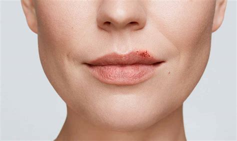 Cold Sore Stages Get Rid Of A Cold Sore Abreva