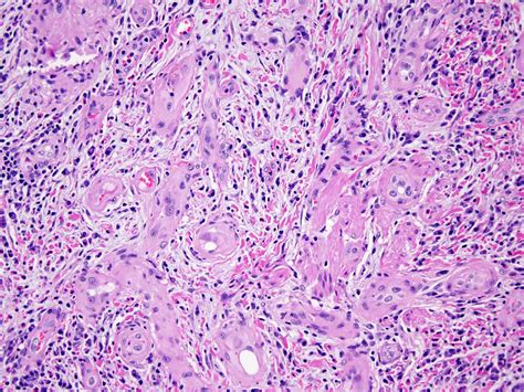 Pathology Outlines Epithelioid Hemangioma