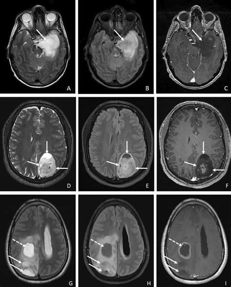 Fluid Attenuation In Ncet In Three Cases Of Glioblastoma Idh Mutant