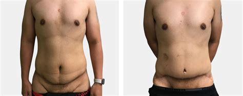 Male Tummy Tuck Before And After Bb Clinic Sydney