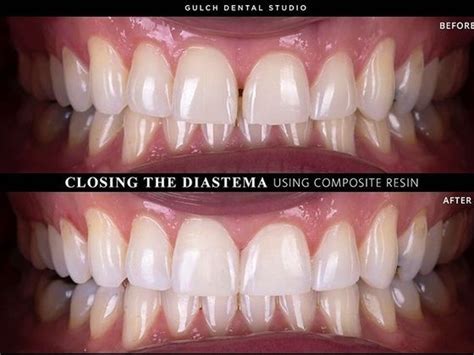 The eruption of the canine teeth closes these gaps. Dental Bonding - Nashville, TN - Gulch Dental Studio