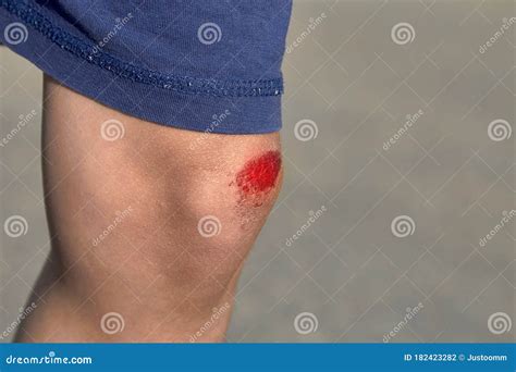 Bruised Wound On The Knee The Boy Fell And Scratched His Knee Stock