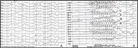 Status Epilepticus In Patients With Juvenile Myoclonic Epilepsy