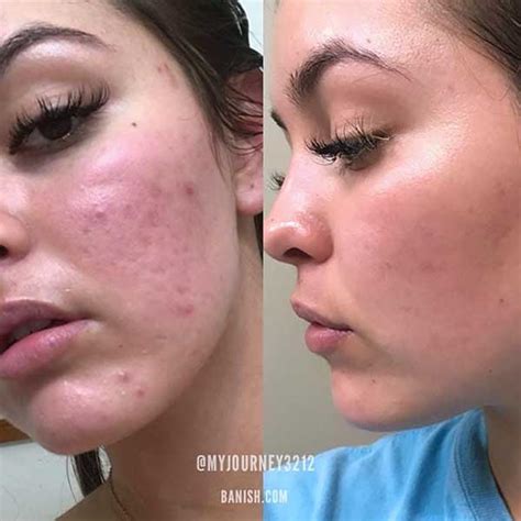 Before And After Banish Untouched Photos Of Acne Scar Results Banish