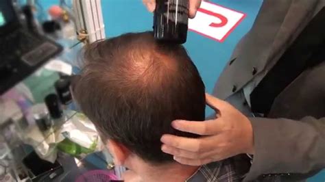 Finding a suitable hairstyle for your thin hairs on crown can be a challenge. Hair Thinning on the Crown - YouTube
