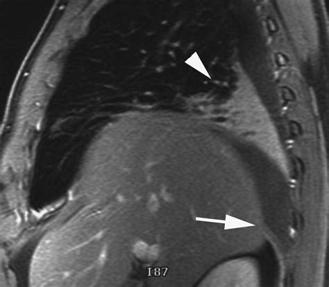 Imaging Of Diaphragmatic Injury A Diagnostic Challenge Radiographics