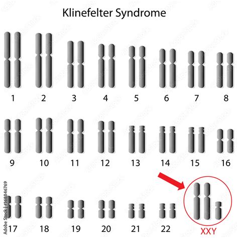 Klinefelter Syndrome Stock Illustration Adobe Stock