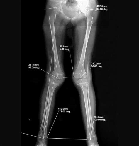 Pre Operative Standing Radiograph Showing Genu Valgum And Lateral