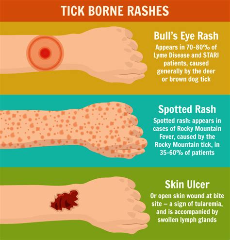 Tick Dangers And Precautions Tick Bite Tick Bite Rash Ticks