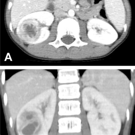Abdominal Contrast Enhanced Computed Tomography Of The Patient A