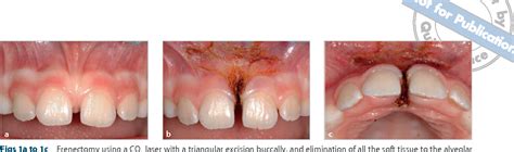 Figure 1 From Does The Maxillary Midline Diastema Close After