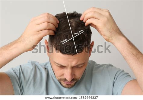 Man Before After Hair Loss Treatment Stock Photo Edit Now