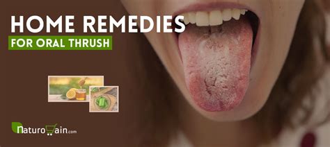 Oral Candida Home Remedy Candida Cure Center Candidiasis Symptome Behandlung