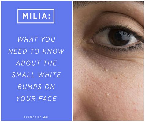 What Are Milia And How Do You Get Rid Of Them By L