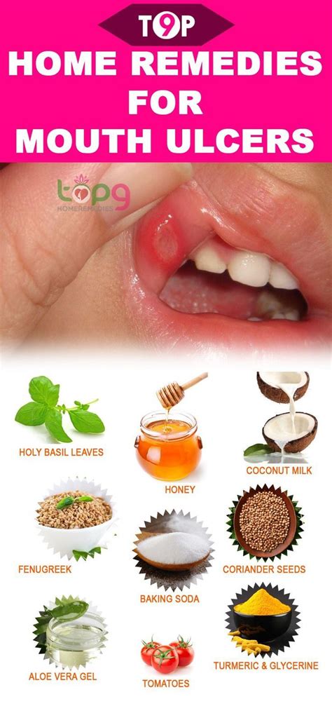 12 amazing home remedies for mouth ulcers with images mouth ulcers canker sore ulcer