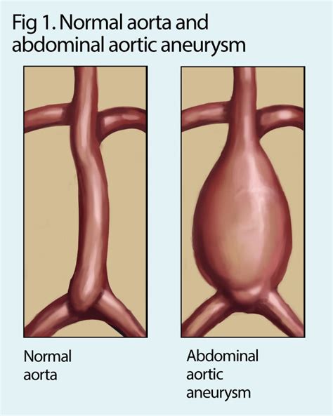 Abdominal Aorta Diameter