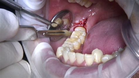 Impacted Lower Wisdom Tooth Extraction Youtube