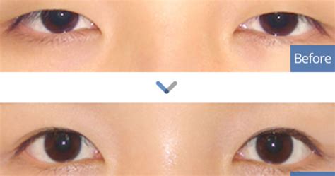 plastic surgery in korea what is the difference between ptosis correction and double eyelid