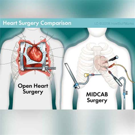 Coronary Artery Bypass Surgery Best Low Cost In Kerala Drmahadevan
