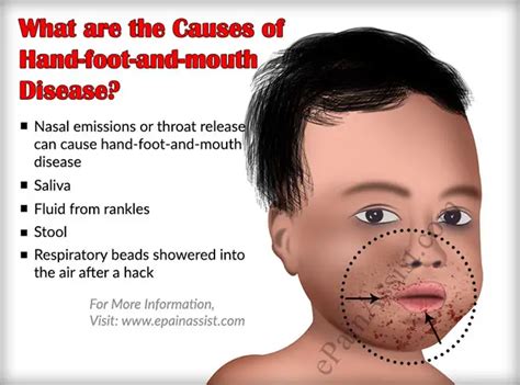 Hand Foot And Mouth Disease Stages