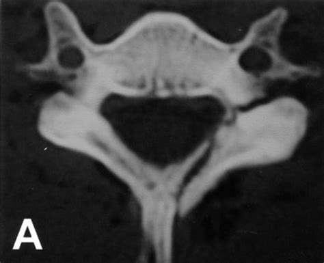 Cervical Lateral Mass Fracture Separation Spine Orthobullets
