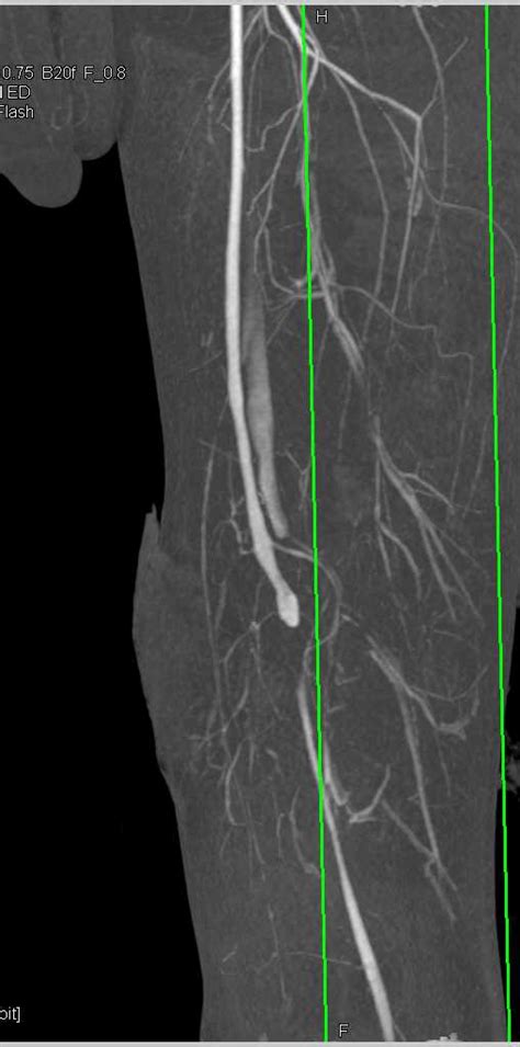 Cta With Laceration Superficial Femoral Artery Sfa With Mid Thigh