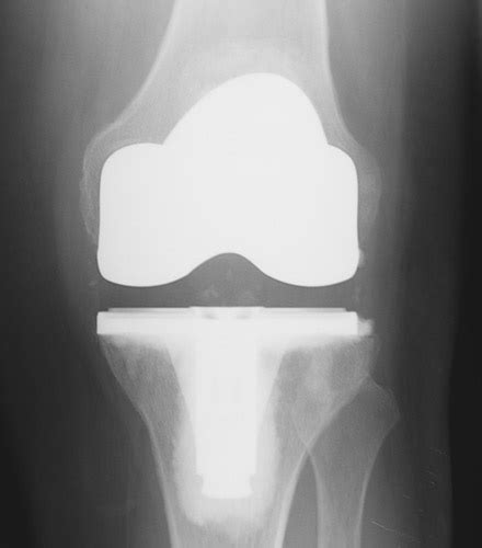 Benefits Of Custom Knee Replacements Home Physio Group