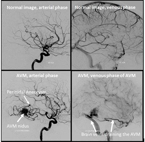 Brain Arteriovenous Malformation Brain Avm Bavm Radiology