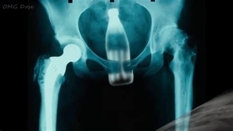 Top 20 Most Weird Objects Found In Human Rectum X Ray Youtube