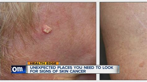 What You Need To Know About Skin Cancer Youtube