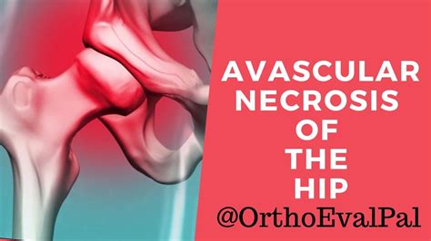 Avascular Necrosis Of The Hip Explained By Paul At Ortho Eval Pal Youtube