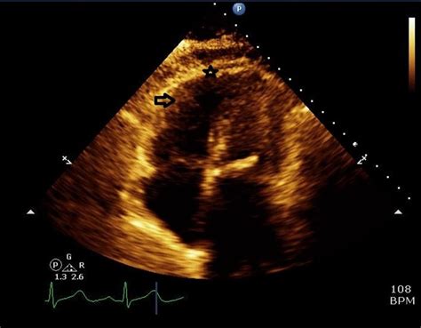 Mcconnells Sign In A Patient With Pulmonary Embolism Bmj Case Reports