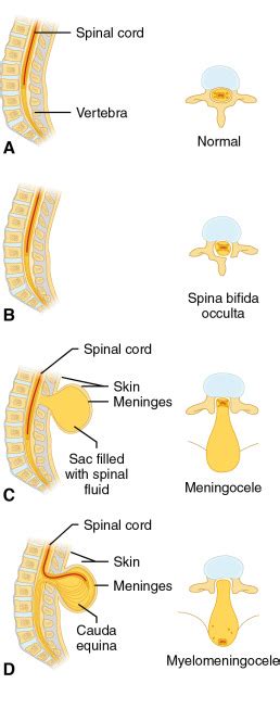 Spina Bifida A Neural Tube Defect Neupsy Key