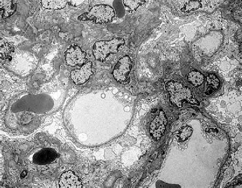 Thin basement membrane disease (tbmd, also known as benign familial hematuria and thin basement membrane nephropathy or tbmn) is, along with iga nephropathy, the most common cause of hematuria without other symptoms. Thin Basement Membrane Diseases - The Best Picture ...
